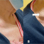 Distensión yugular: lo que revela una vena inflamada en el cuello sobre tu salud