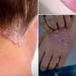 Señales del Papiloma Humano que Debes Conocer y Tener en Cuenta