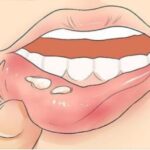 Herpes labial: Ampollas o llagas. Descubre cómo sanarte de manera efectiva