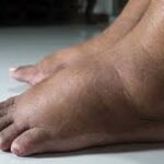Adiós a los pies hinchados: Causas comunes y soluciones efectivas