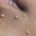 Molusco contagioso: una infección de la piel común y fácil de tratar