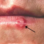 El mensaje detrás de las ampollas causadas por el herpes simple