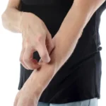 La picazón que parecía una alergia, pero era algo más