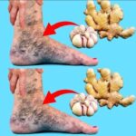 Adiós a las Varices: La Mezcla Natural que Debes Aplicar Antes de Dormir