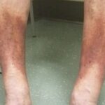 Hiperpigmentación Marrón-Oscura en las Piernas: Signos de Problemas Circulatorios y Dermatitis Ocre