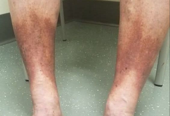 Hiperpigmentación en las piernas