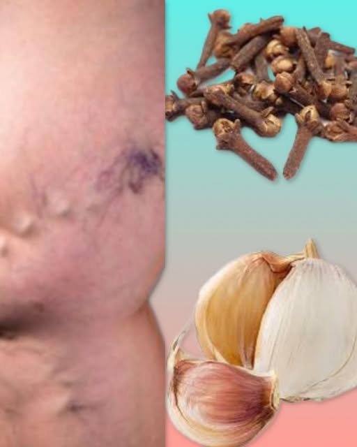 Remedios Naturales para el Dolor de Piernas