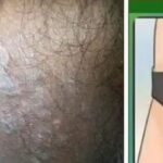 Todo sobre la Tiña Inguinal: Causas, Síntomas y Tratamientos