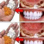 Blanqueamiento Dental en 2 Minutos: La Verdad Oculta por los Dentistas