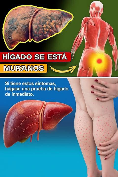 Señales de cirrosis hepática