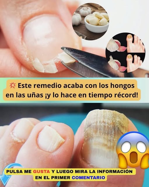 Remedio natural para hongos en las uñas