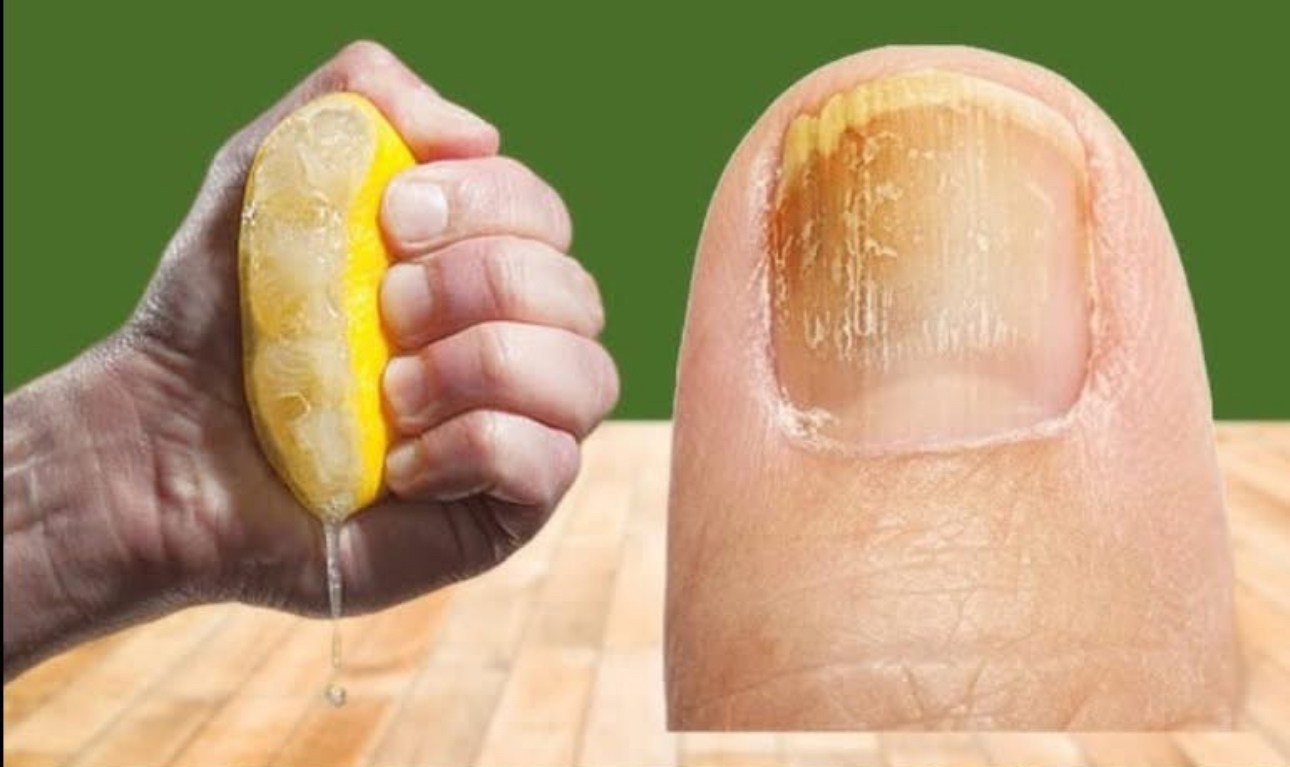 Hongos en las Uñas de los Pies