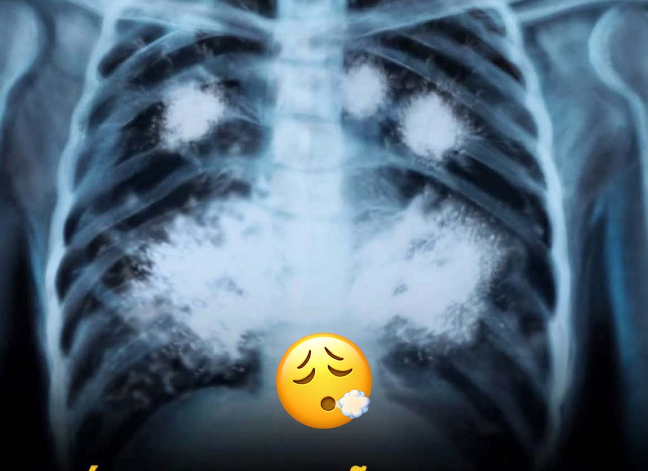 Consecuencias del vapeo