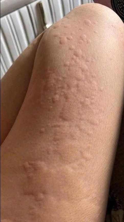 Salpullido en la piel