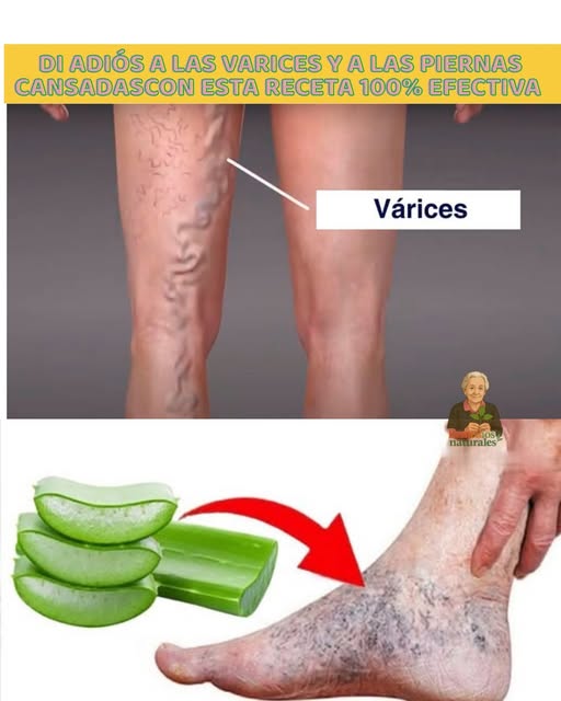 Aloe Vera para el tratamiento de varices