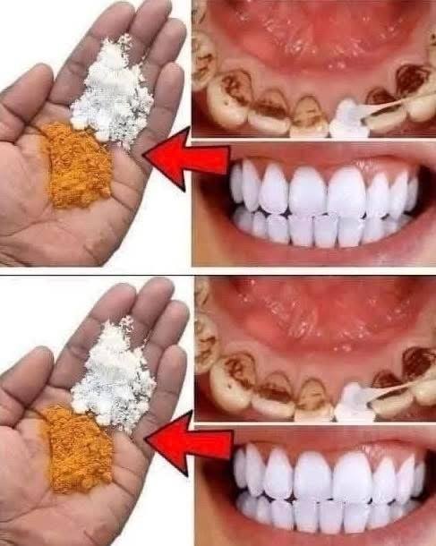 Remedio casero para blanquear dientes con bicarbonato y cúrcuma
