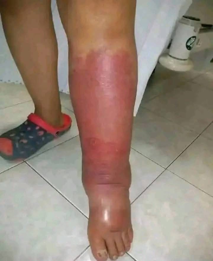 Síntomas de infección en la pierna