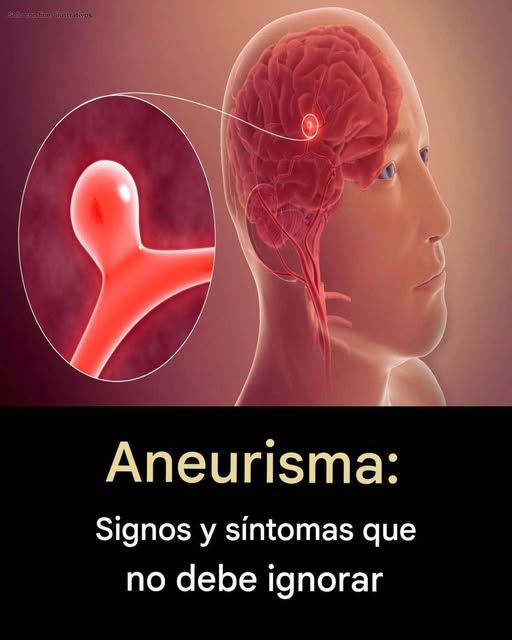 Aneurisma: Signos y síntomas que no debe ignorar