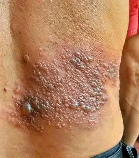 Erupción cutánea que podría ser herpes zóster