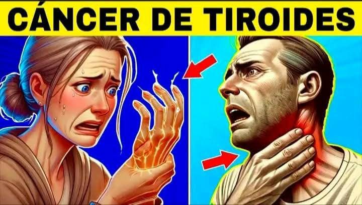 Cáncer de Tiroides