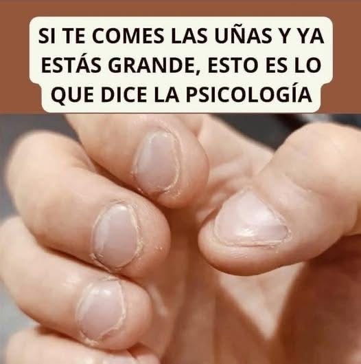 Uñas mordidas