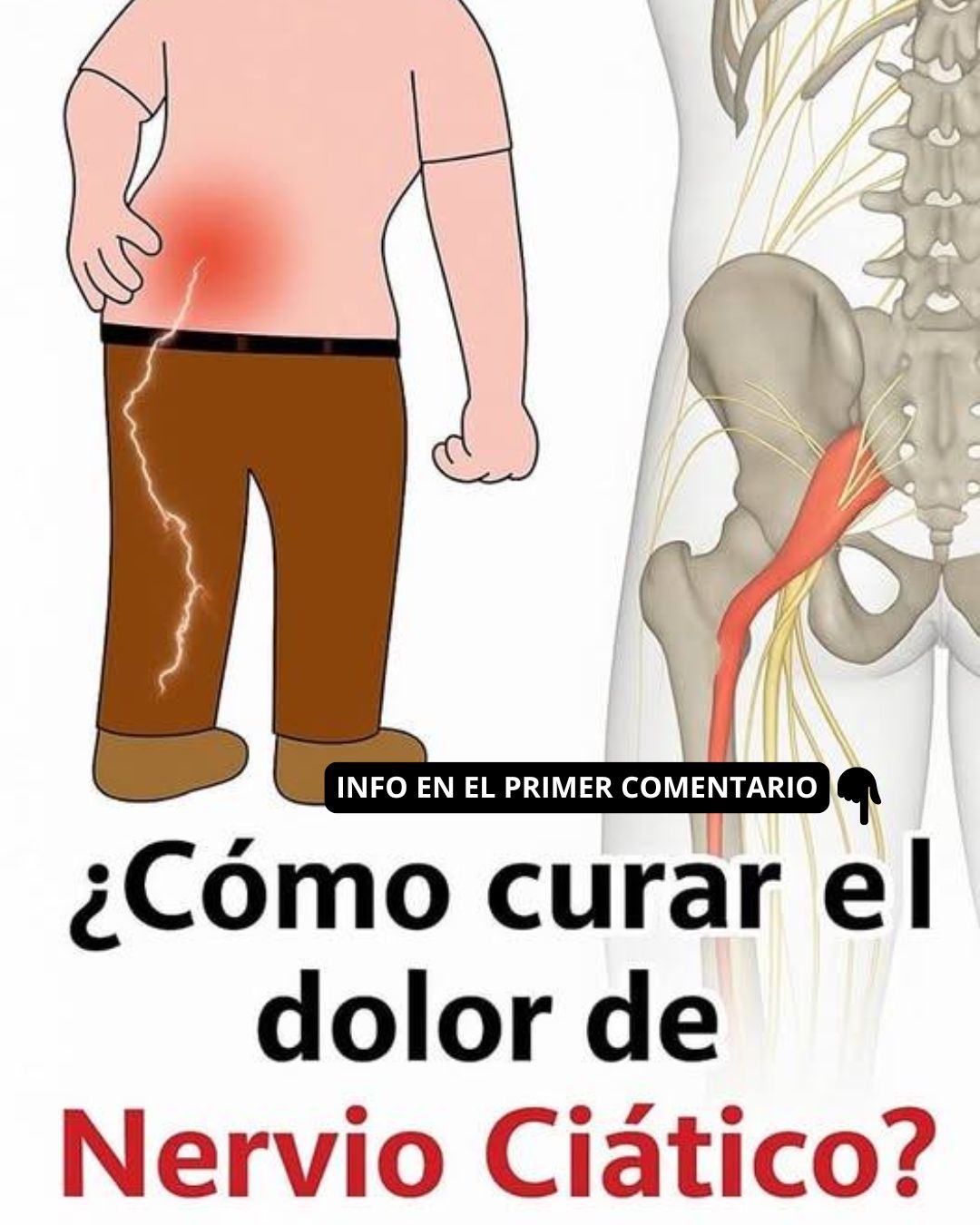 Ilustración del dolor ciático