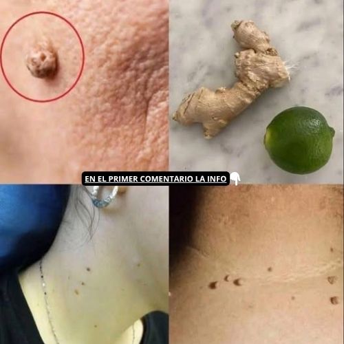 Remedios caseros para verrugas