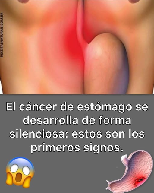 Gráfico sobre los síntomas del cáncer de estómago