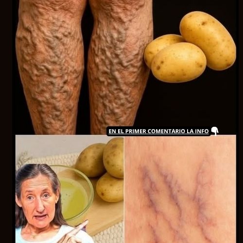 Remedios naturales para las várices
