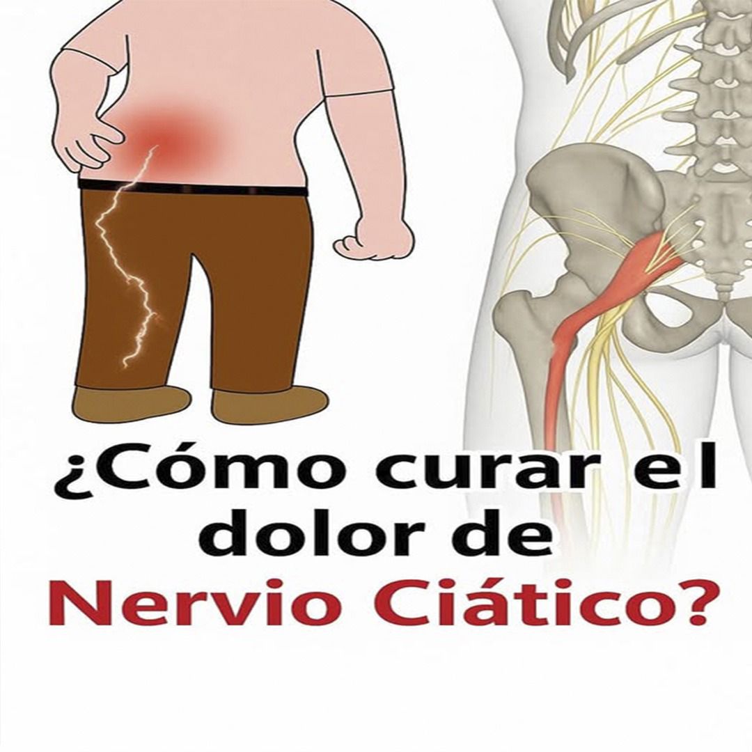 Ilustración del dolor del nervio ciático.