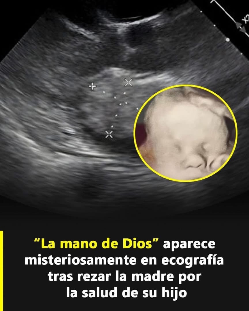 Ecografía mostrando la 'mano de Dios' protegiendo al bebé