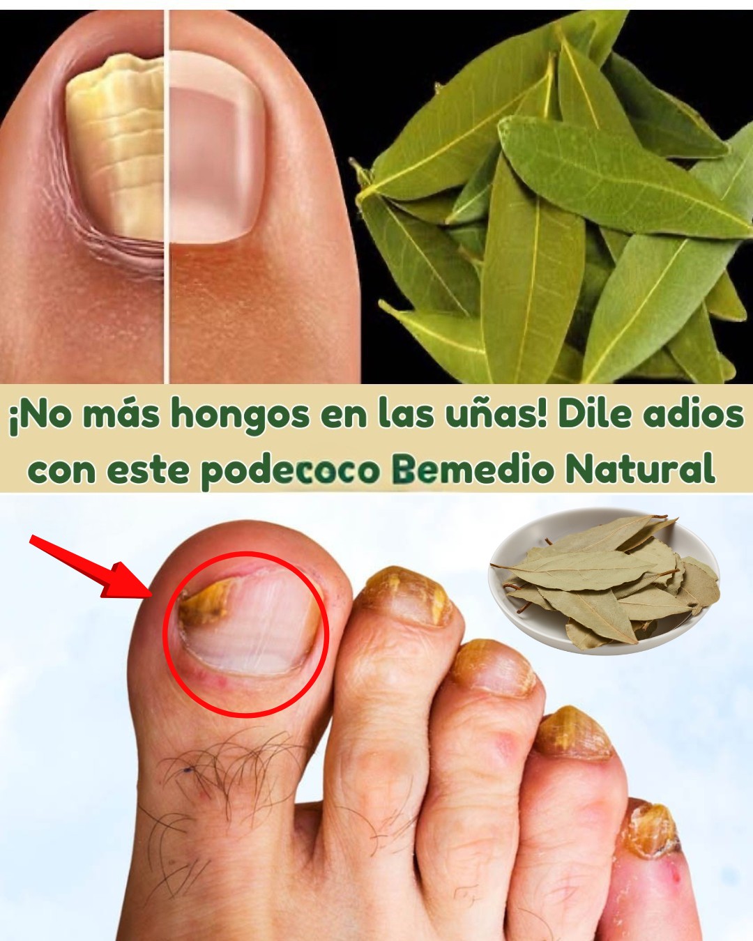 Remedio Natural para hongos en las uñas con laurel
