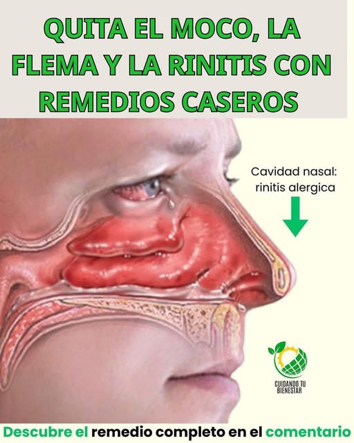 Diagrama de la cavidad nasal enfocándose en la rinitis alérgica