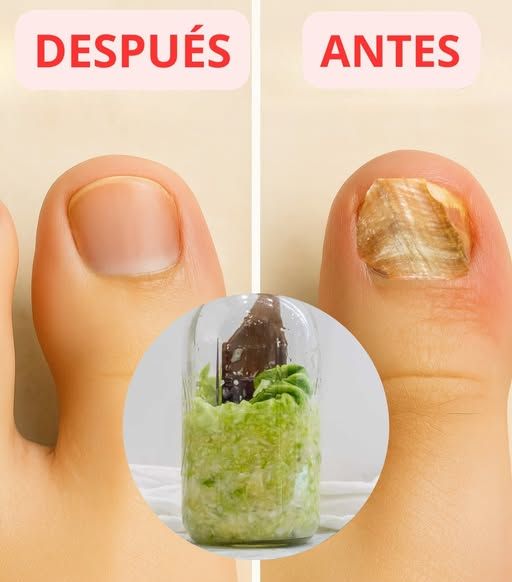 Antes y después del tratamiento antimicótico