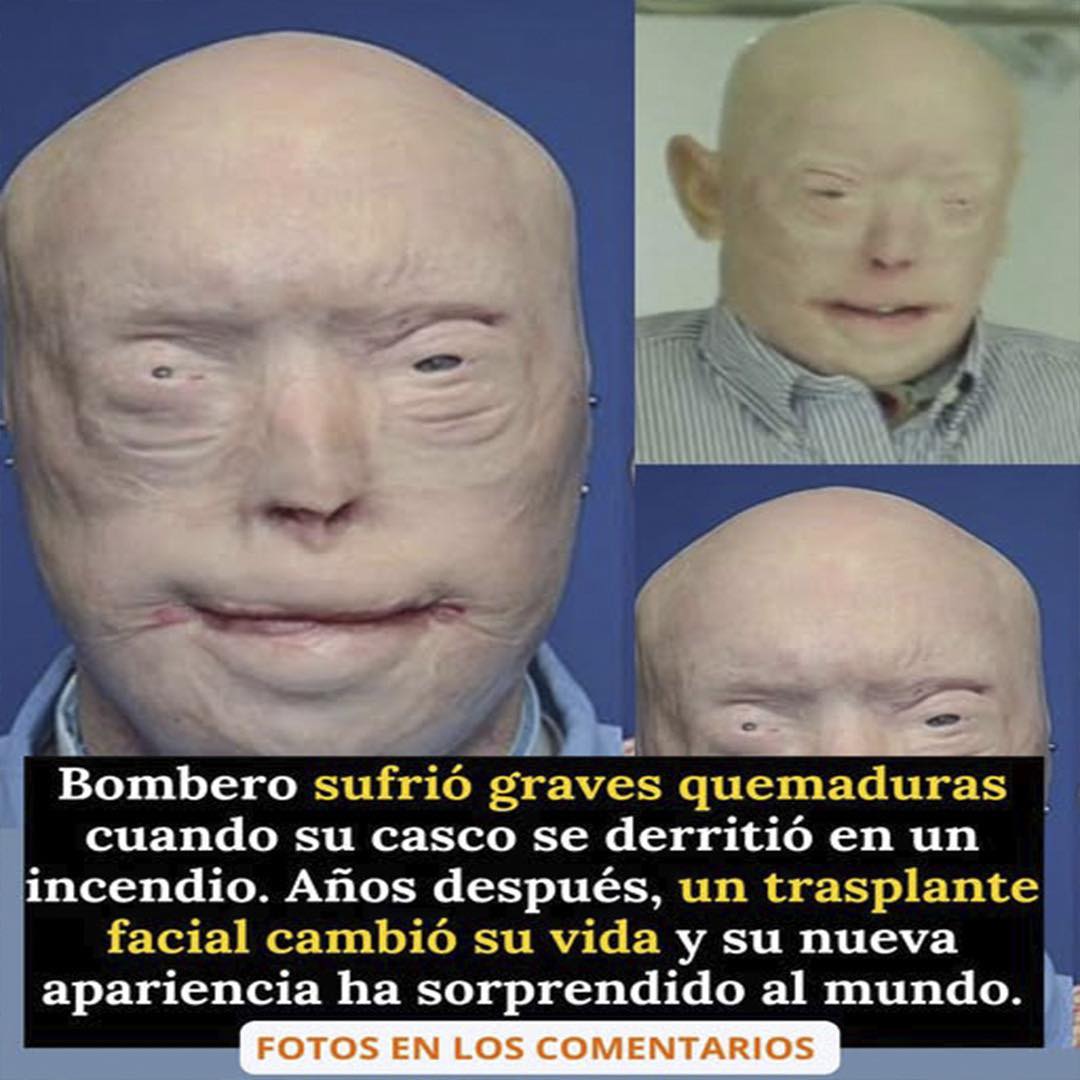 Bombero Trasplante Facial