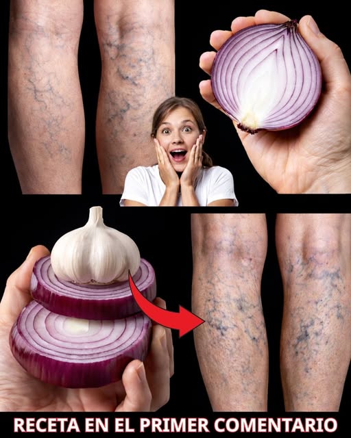 Cebolla morada y ajo como remedios naturales para las várices
