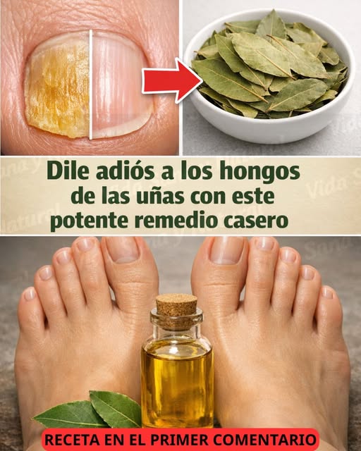 Remedio natural con hojas de laurel para hongos en las uñas