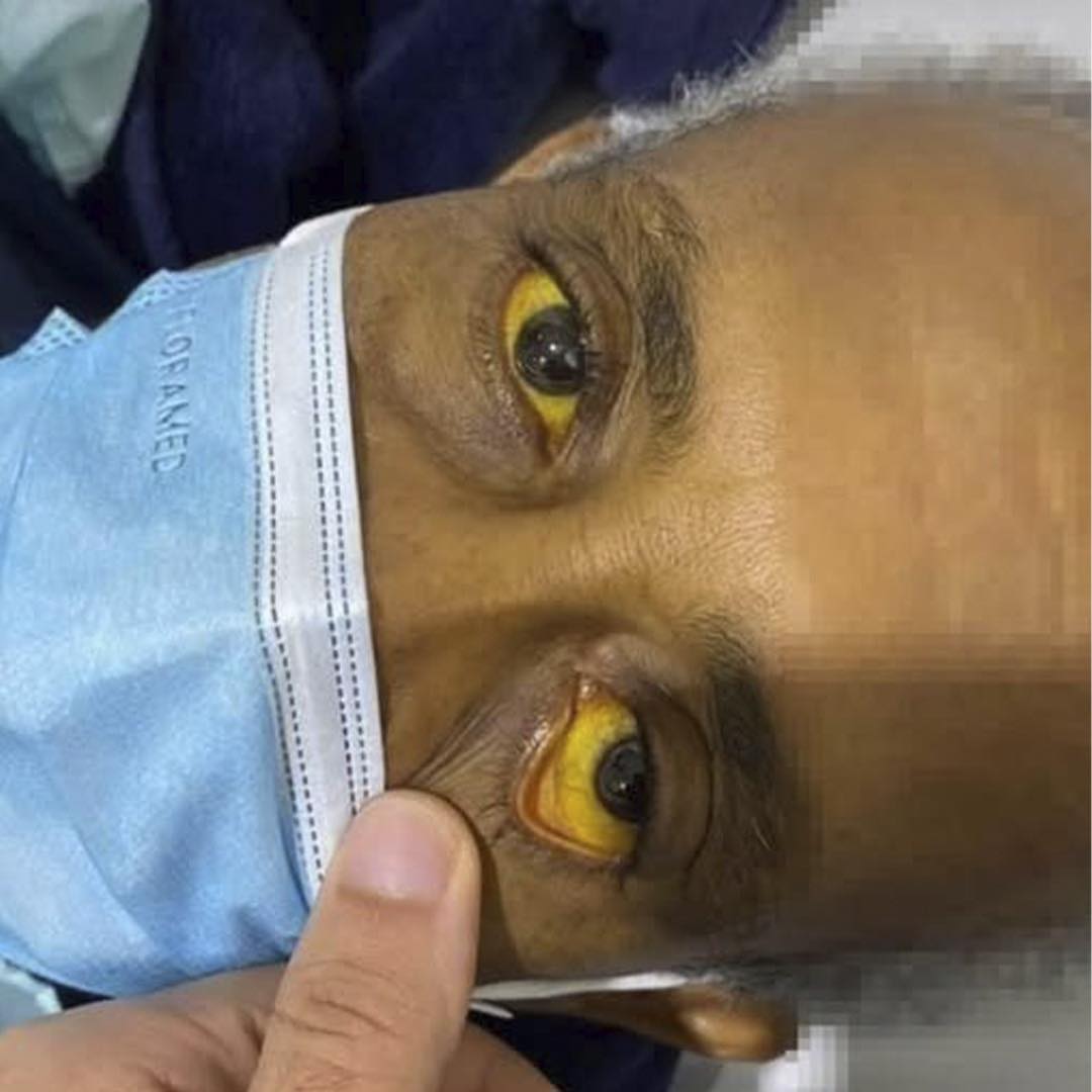 Ojos amarillos por hepatitis