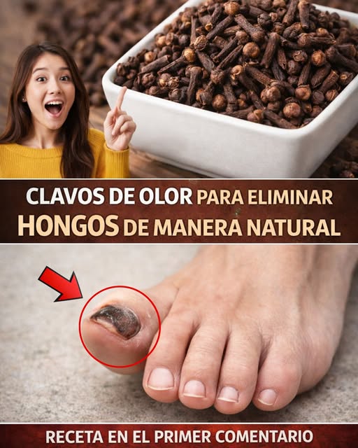 Remedio natural con clavos de olor para eliminar hongos en las uñas