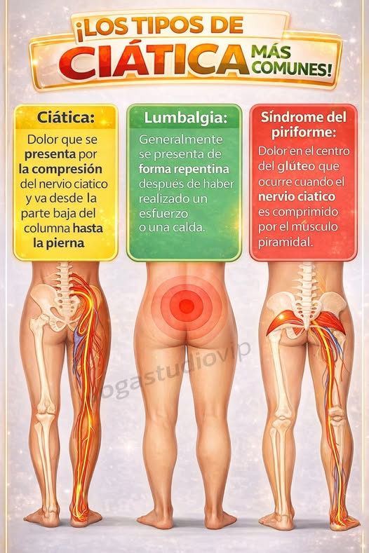 Infografía de tipos de ciática