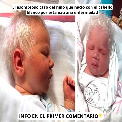 Niño con cabello blanco