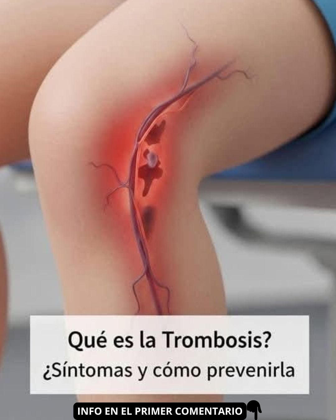 Representación médica de la trombosis en una pierna