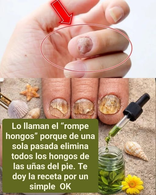 Remedio natural para hongos en las uñas