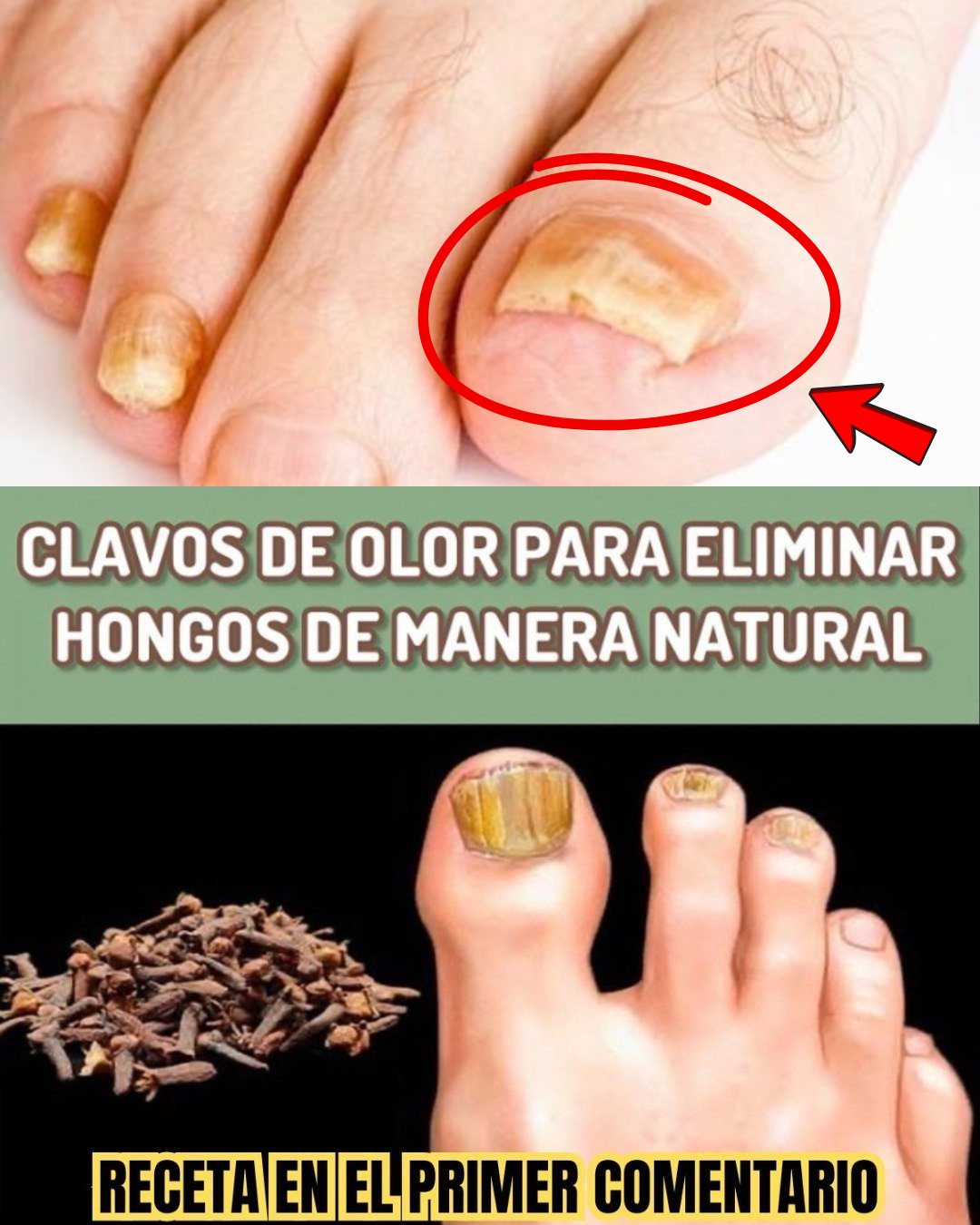 Hongo en uñas tratado con clavos de olor
