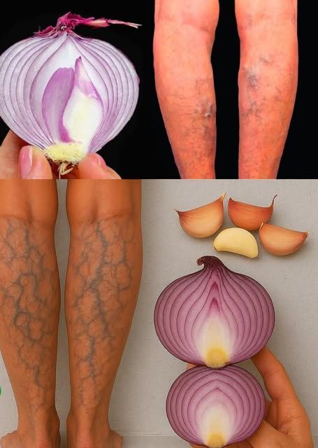Remedio casero para várices con ajo y cebolla